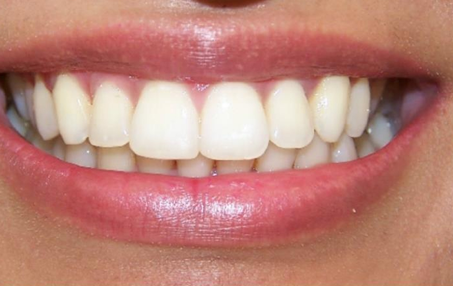 Best-E-Max-Veneers-Dubai.jpg