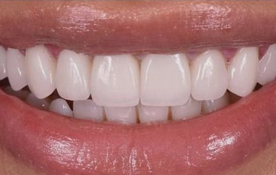 Best-E-Max-Veneers.jpg