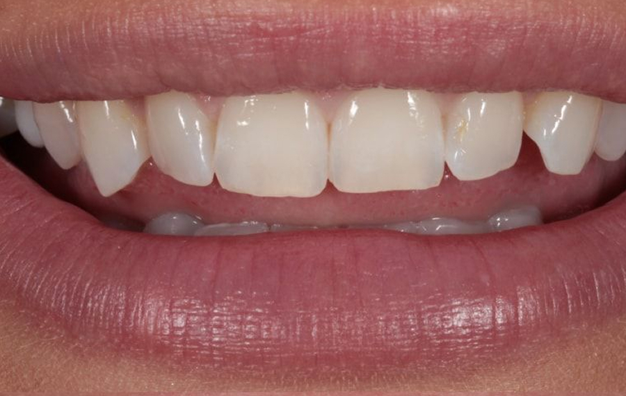 Best Nano Teeth Whitening Dubai