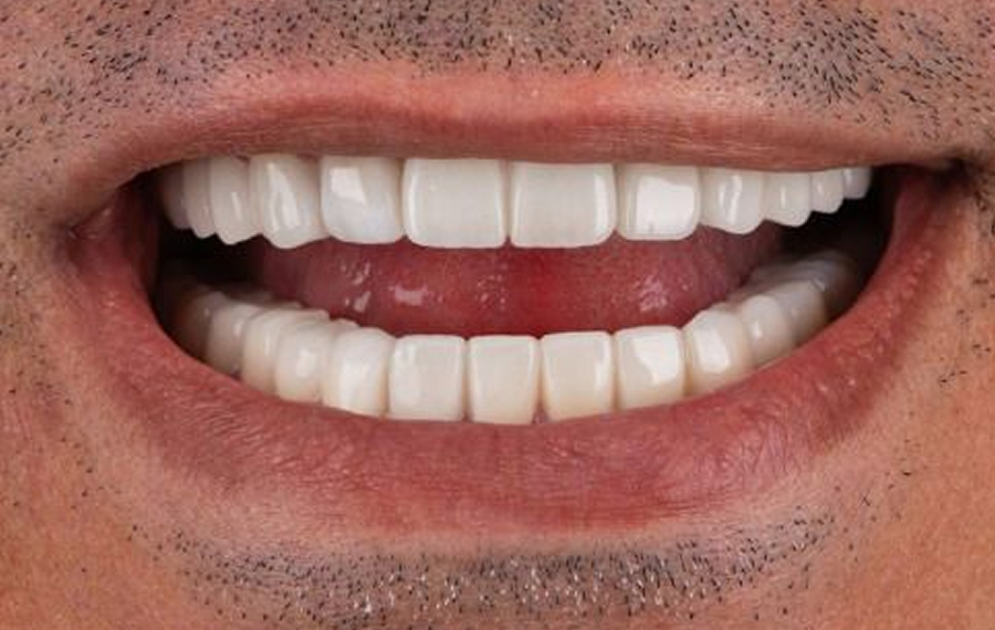 Best-Tooth-Extraction-in-Dubai.jpg