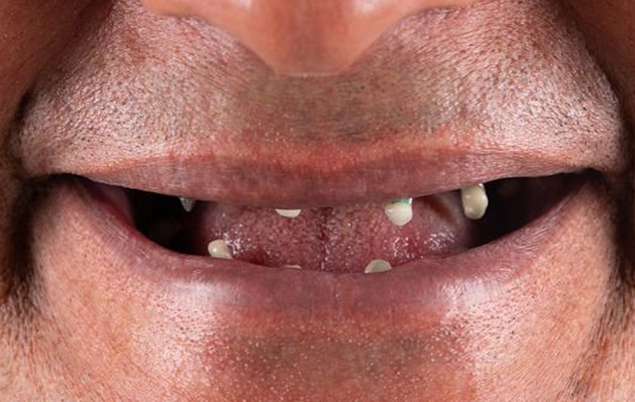 Best-Tooth-Extraction.jpg Best-Tooth-Extraction.jpg