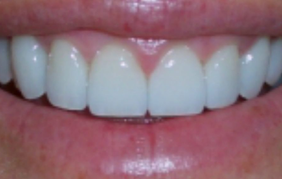 Best-Zoom-Teeth-Whitening.jpg