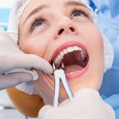 Dental Extraction in Dubai Best Tooth
