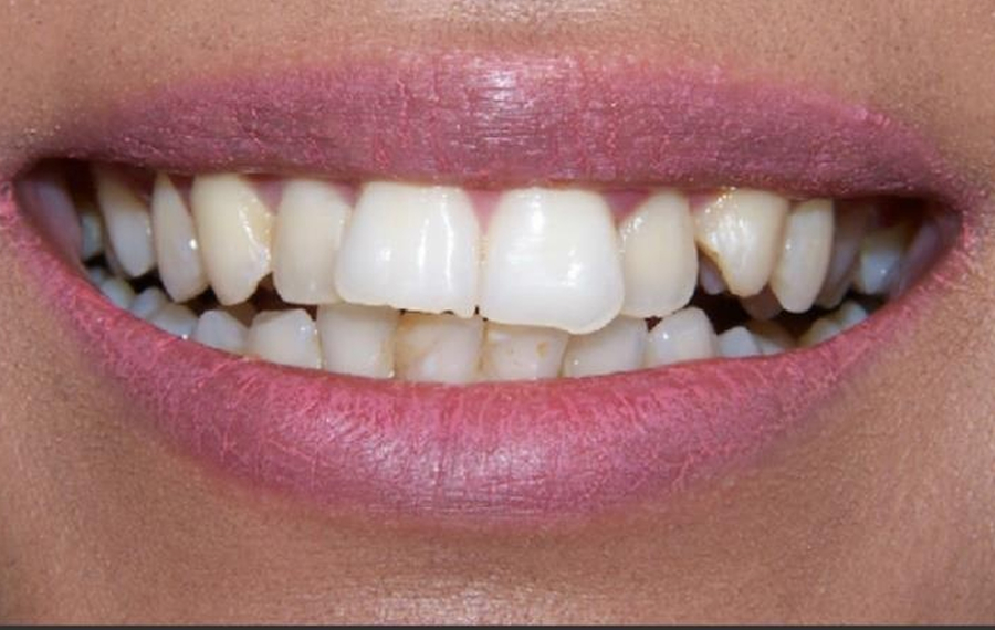 E-Max-Veneers-Dubai.jpg