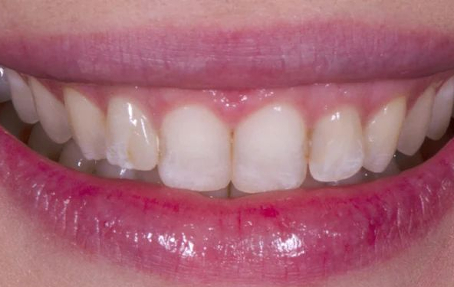 E-Max-Veneers-in-Dubai.jpg