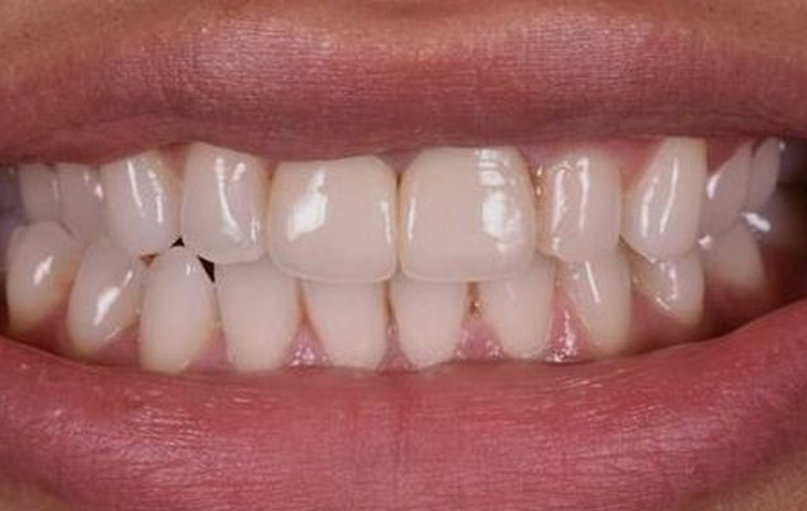E-Max-Veneers.jpg