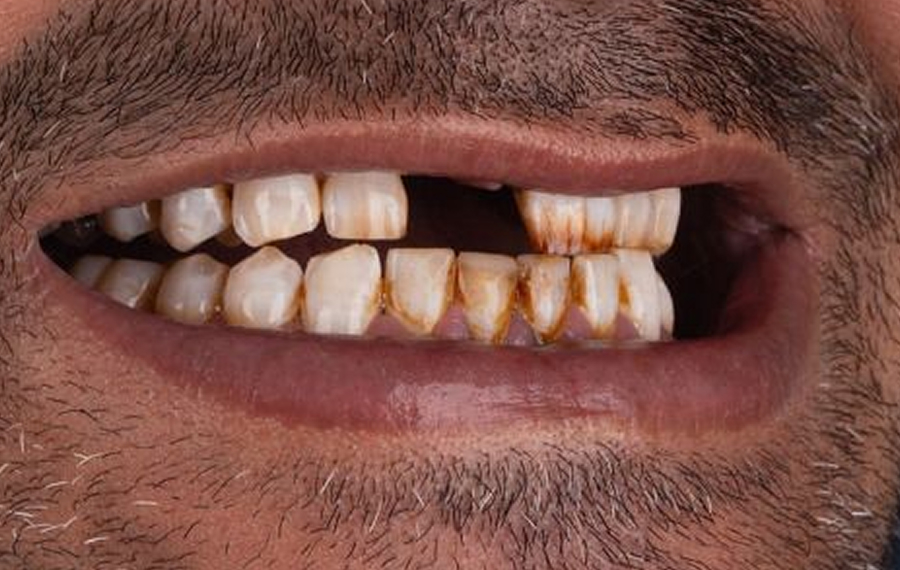 Tooth-Extraction-Dubai.jpg Tooth-Extraction-Dubai.jpg