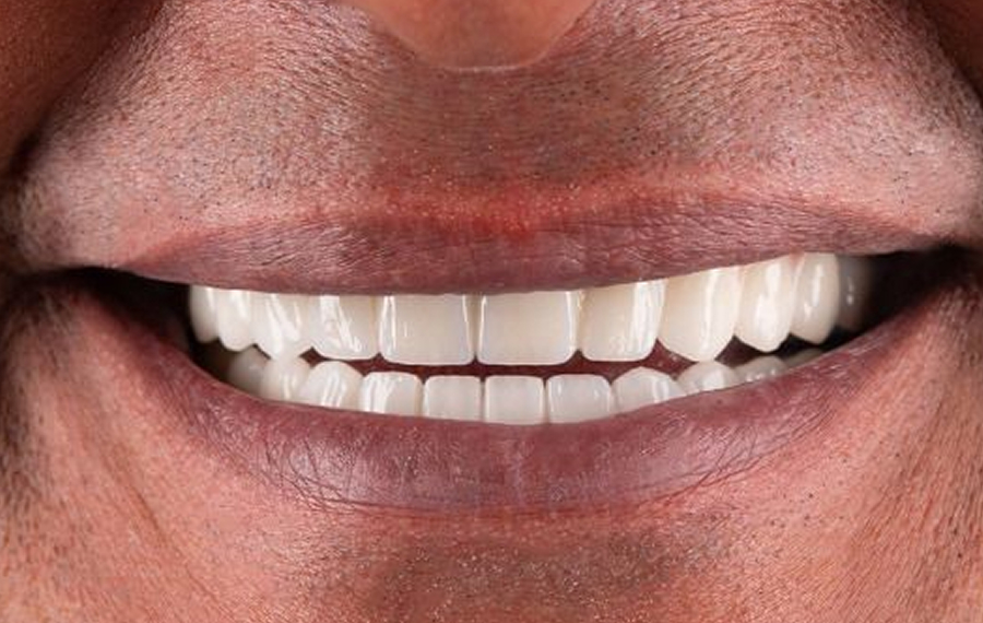 Tooth-Extraction-in-Dubai.jpg