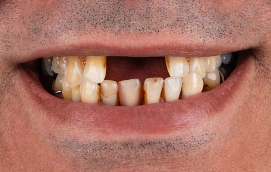 Tooth-Extraction.jpg Tooth-Extraction.jpg