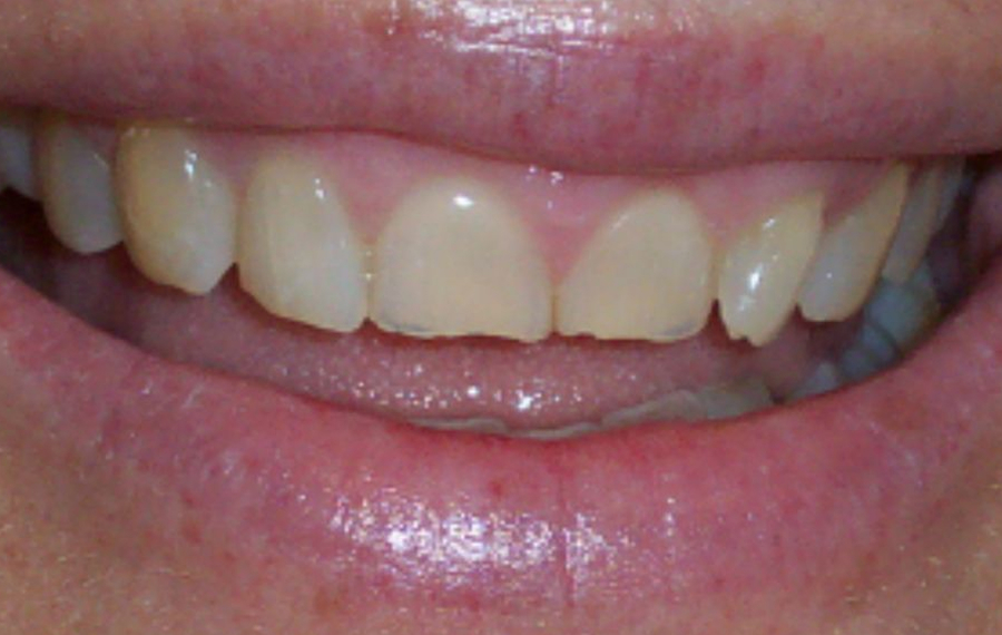 Zoom-Teeth-Whitening-in-Dubai.jpg