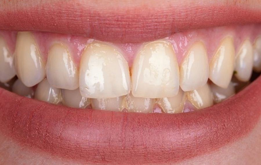 Zoom-Teeth-Whitening.jpg