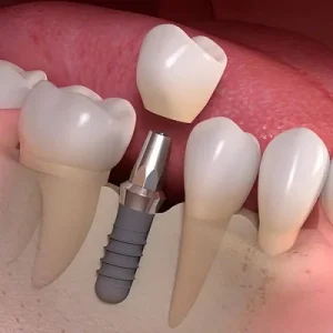 3 أنواع من زراعة الأسنان وأيها الأنسب لك؟ 3 3 أنواع من زراعة الأسنان وأيها الأنسب لك؟