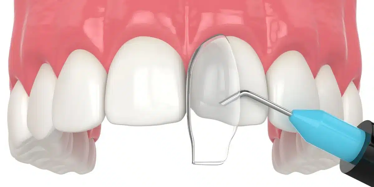 تكلفة التقويم التجميلي للأسنان في دبي