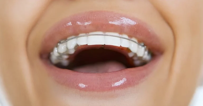 ما هي الأنواع المختلفة لمثبتات الأسنان