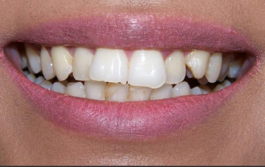 Aligners Dubai.jpg Aligners Dubai.jpg