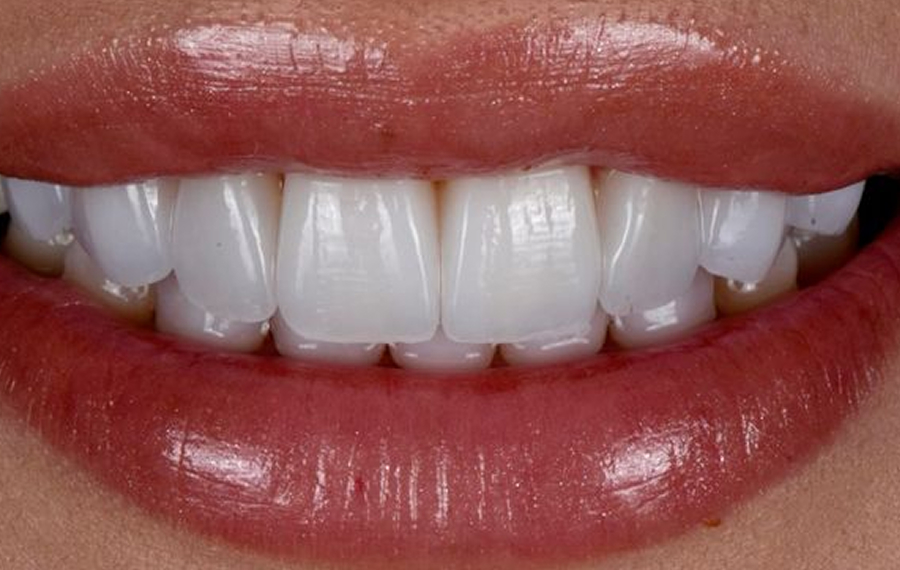 Aligners for Dubai.jpg
