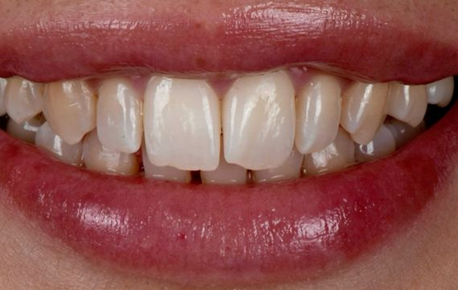 Aligners in Dubai.jpg Aligners in Dubai.jpg