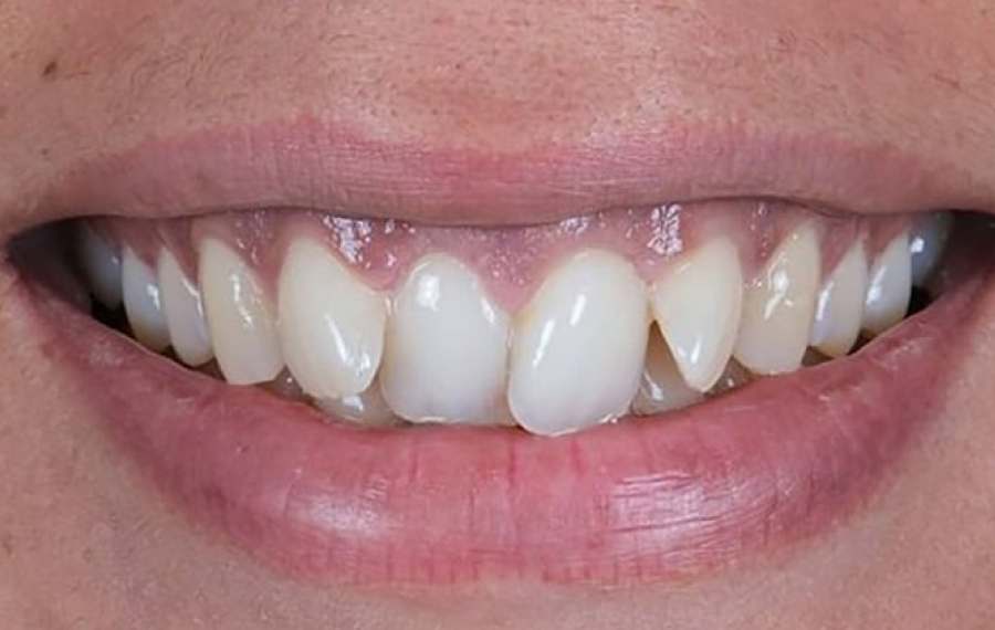 Aligners.jpg Aligners.jpg