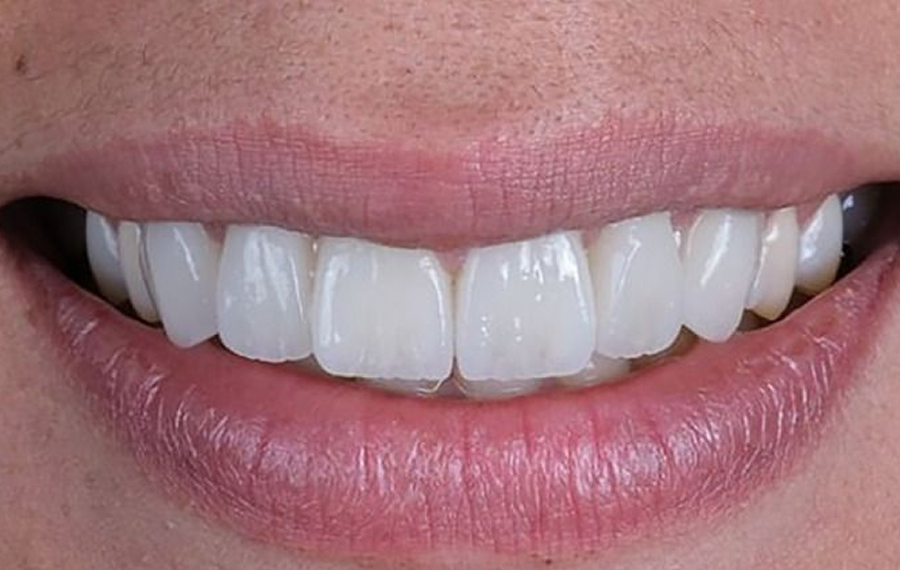 Best Aligners.jpg