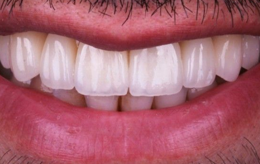 Best Crowded Teeth Treatment Dubai.jpg