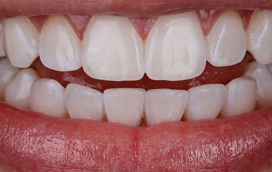Best Crowded Teeth Treatment in Dubai.jpg