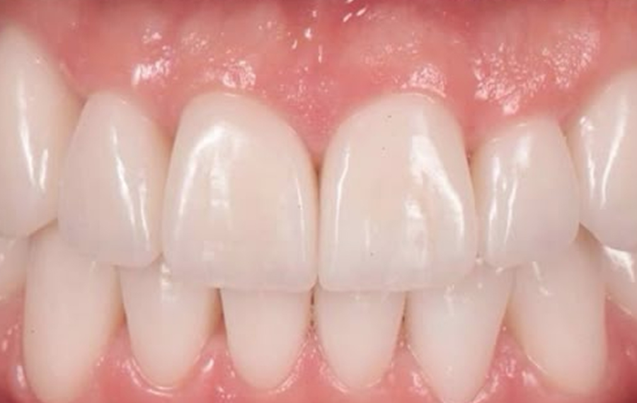 Best Dental Braces.jpg