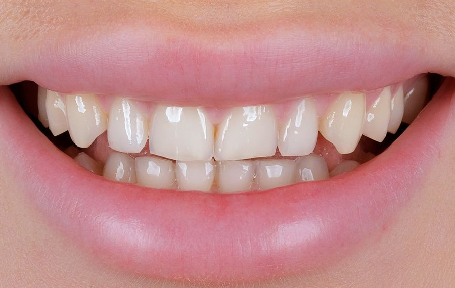 Best Dental Stains Removal in Dubai.jpg