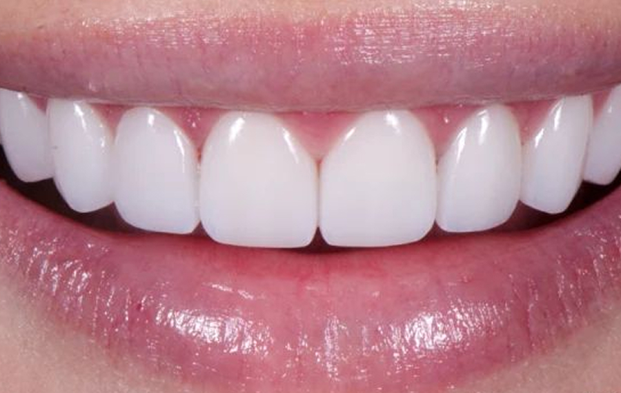 Best Dental Stains Removal.jpg