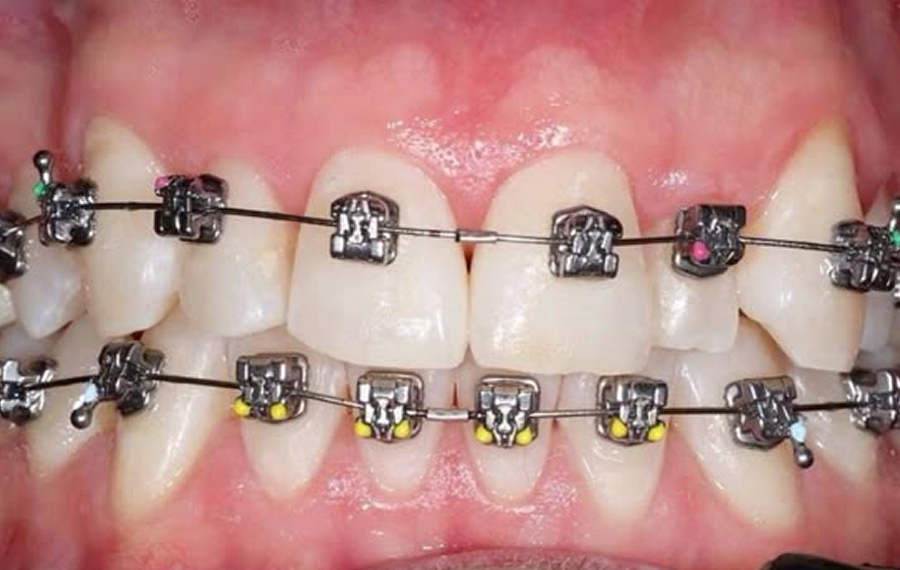 Best Metal Braces Dubai.jpg Best Metal Braces Dubai.jpg