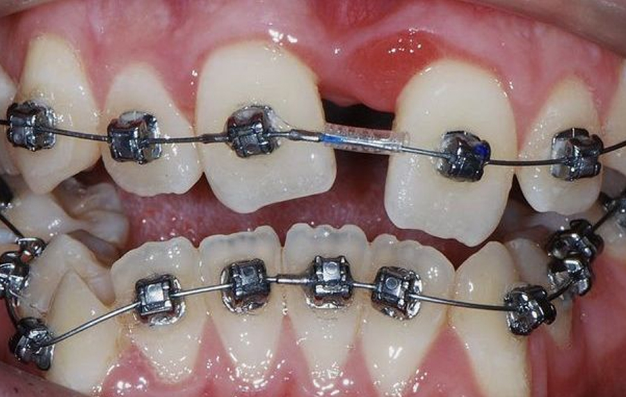 Best Metal Braces in Dubai.jpg Best Metal Braces in Dubai.jpg