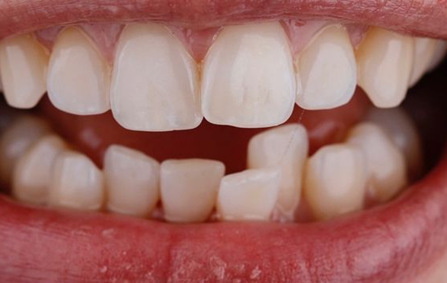 Crowded Teeth Treatment Dubai.jpg Crowded Teeth Treatment Dubai.jpg