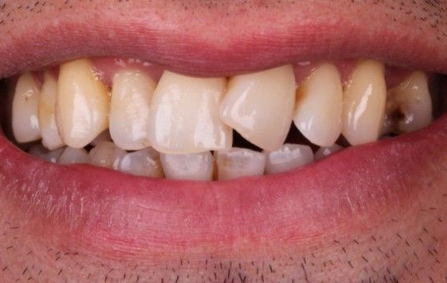 Crowded Teeth Treatment.jpg Crowded Teeth Treatment.jpg