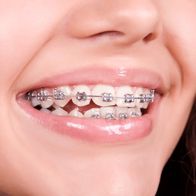 Dental Braces in Dubai.webp