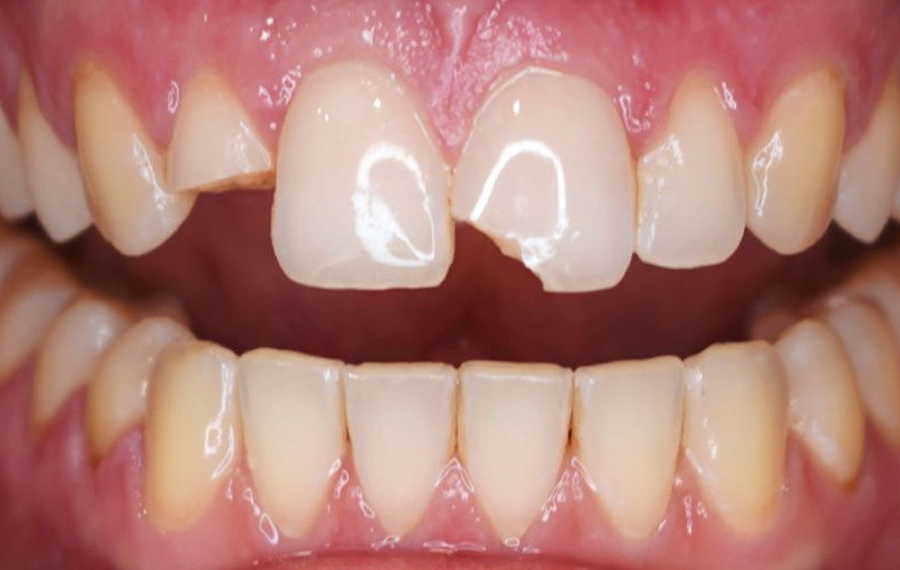 Dental Stains Removal Dubai.jpg
