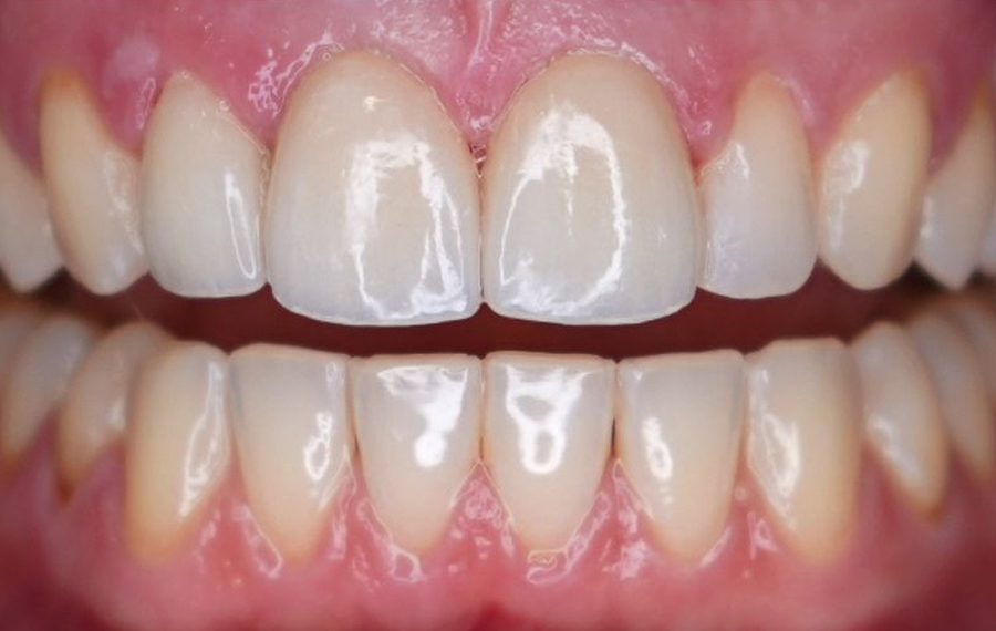 Dental Stains Removal.jpg