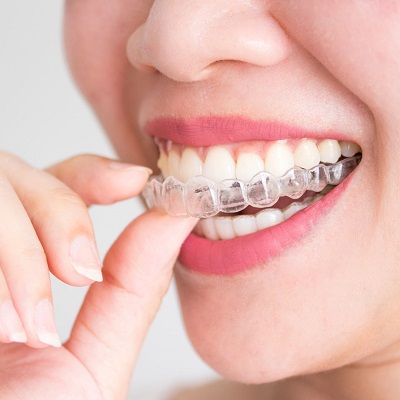 Invisalign Aligners in Dubai Best Aligners Dubai.jpg
