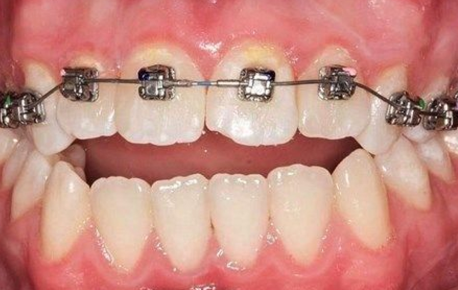 Metal Braces Dubai.jpg Metal Braces Dubai.jpg