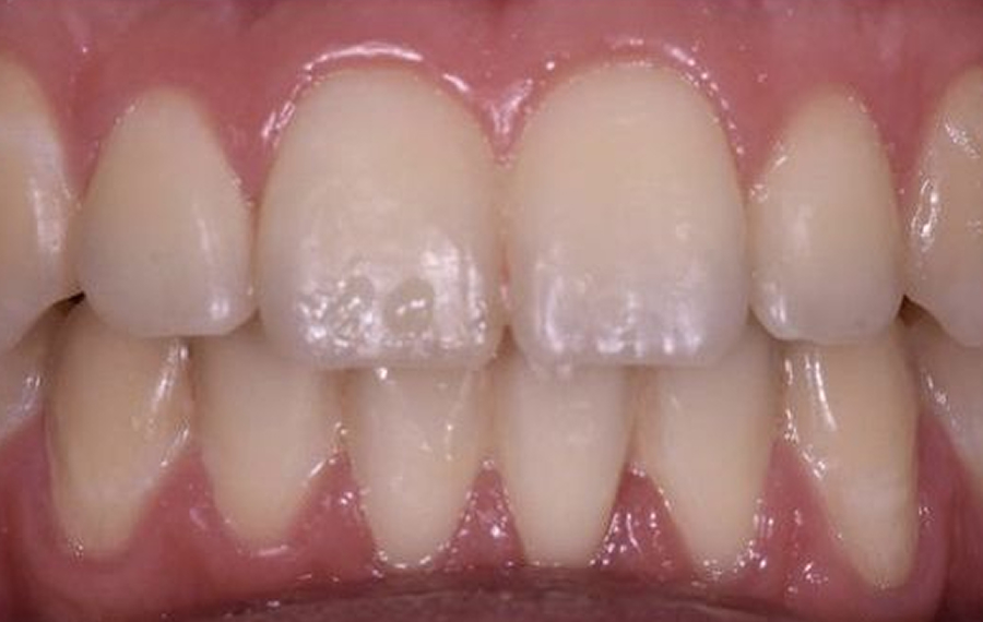 Metal Braces in Dubai.jpg