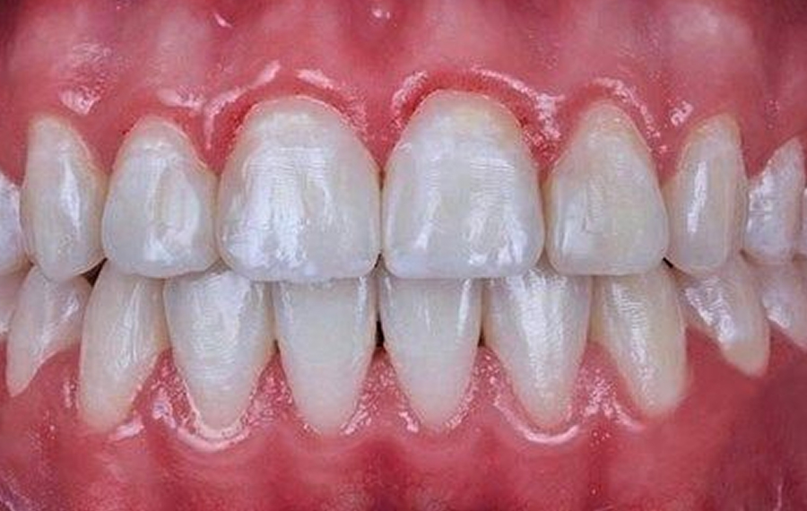 Metal Braces.jpg