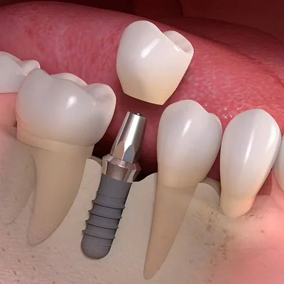 3 Types of Dental Implants and Which One is Best for You?