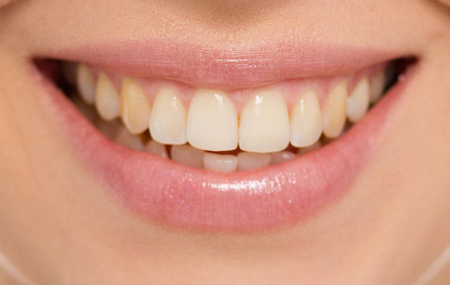 Patient before professional teeth cleaning in Dubai displaying visible yellowing at Enfield Dental Clinic Patient before professional teeth cleaning in Dubai displaying visible yellowing at Enfield Dental Clinic