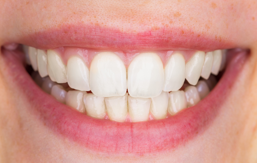 After professional teeth cleaning in Dubai at Enfield Royal Clinic showing visibly whiter, plaque-free, and polished teeth