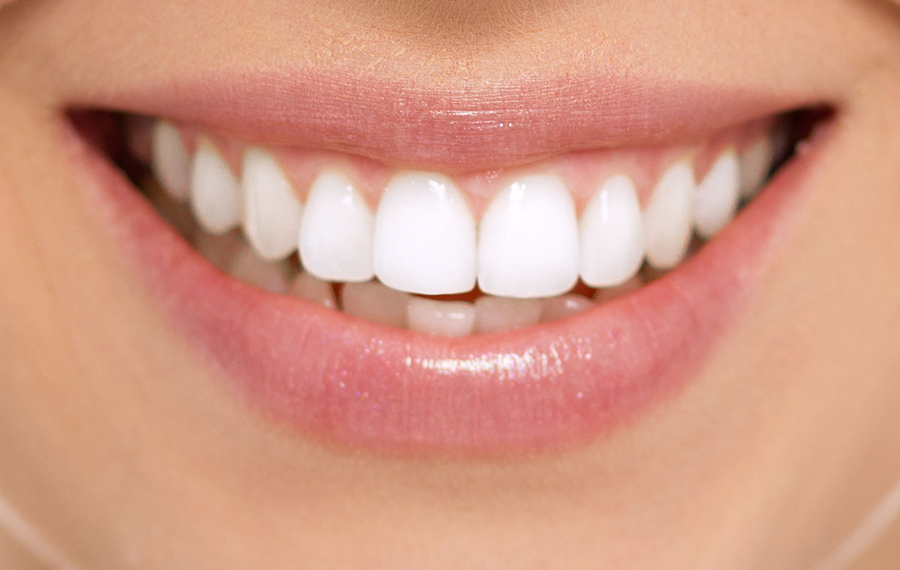 Patient after teeth cleaning in Dubai displaying clean, bright, and healthy gums with no calculus deposits at Enfield Dental Clinic