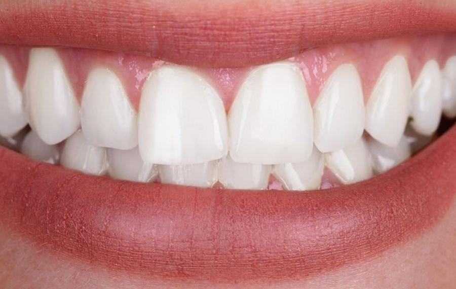 Best-Zoom-Teeth-Whitening-Dubai.jpg