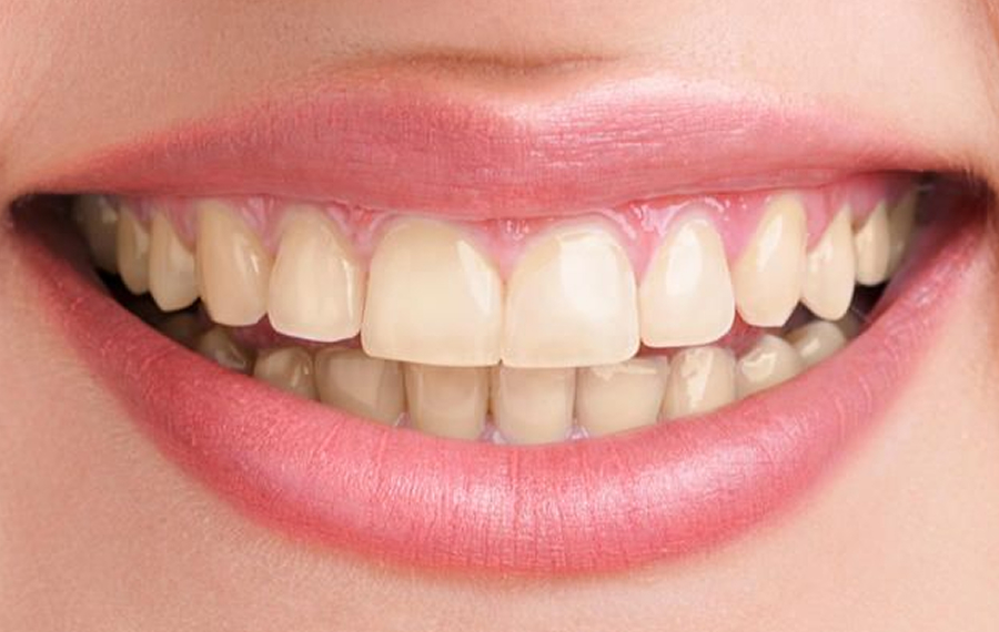 Best-Zoom-Teeth-Whitening-in-Dubai.jpg