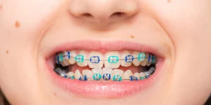 How Long Does It Take for Braces to Straighten Teeth