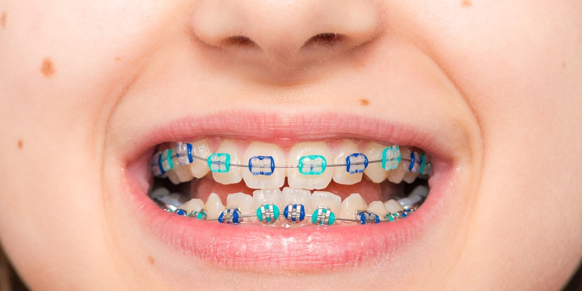 Braces to Straighten Teeth