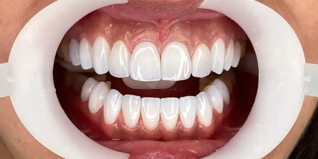 Blogs 20 Composite Veneers Dubai Price