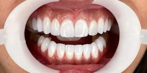 Composite Veneers Dubai Price 1 Composite Veneers Dubai Price