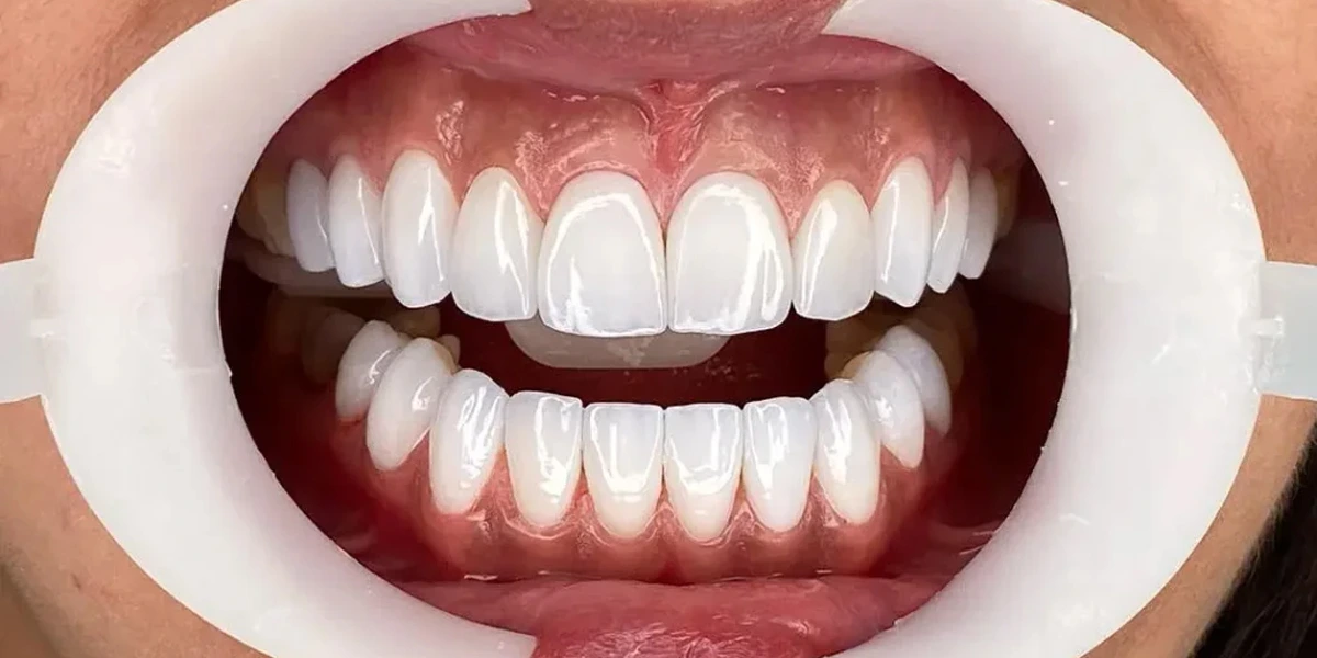 Composite Veneers Dubai Price